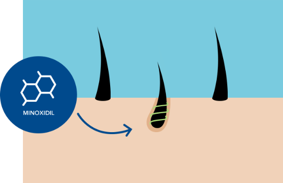 Illustration of hair follicles on a light blue background depicts how minoxidil works on the scalp