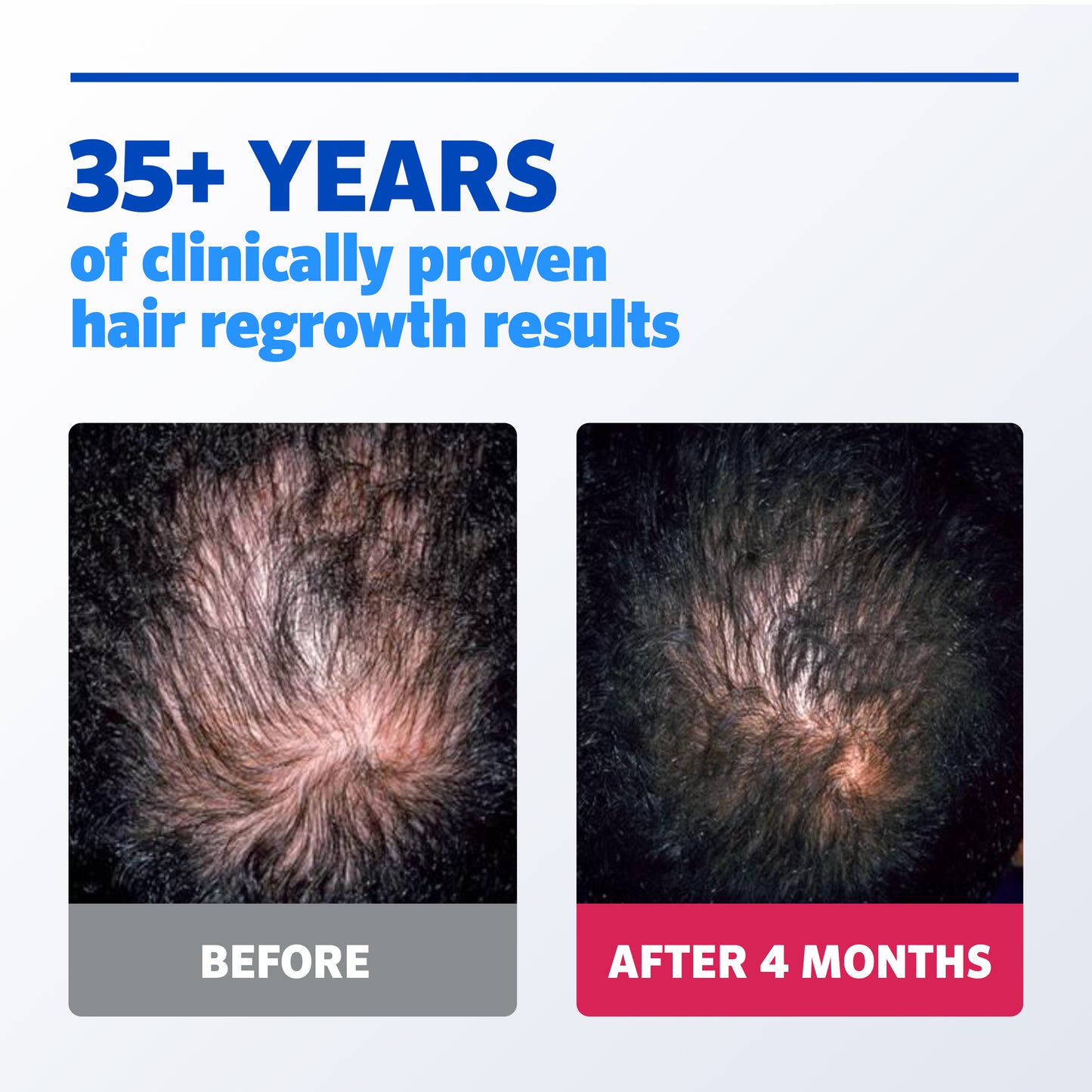 Before and after image of man with brown hair showing visible hair regrowth after 4 months of using Men’s Rogaine treatments.
